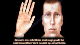 Skin Warts , Hand warts – Everything You Need To Know