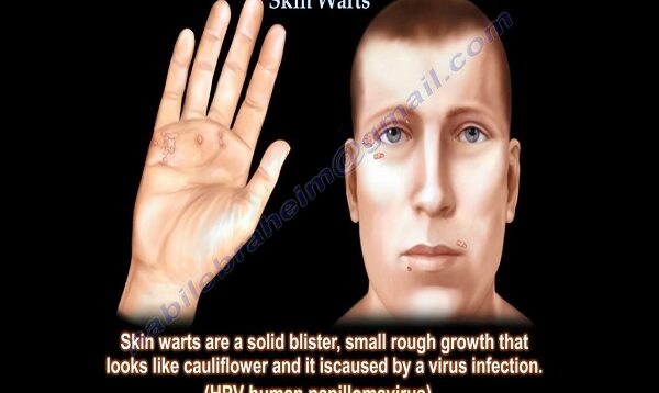 Skin Warts , Hand warts – Everything You Need To Know