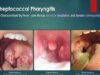Streptococcal Pharyngitis