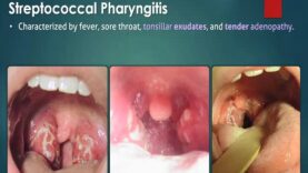 Streptococcal Pharyngitis