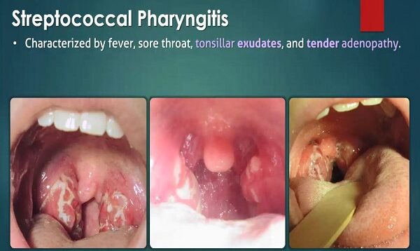 Streptococcal Pharyngitis