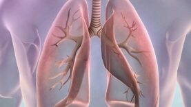Symptoms of lung cancer