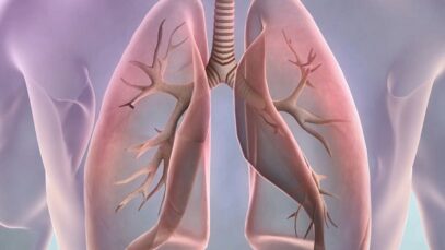 Symptoms of lung cancer