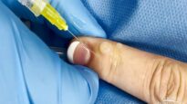 Wart or Cyst. Extracting a Bump on the Finger