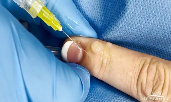 Wart or Cyst. Extracting a Bump on the Finger