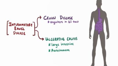 Crohn’s disease (Crohn disease) – causes, symptoms pathology