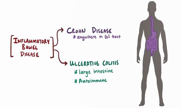 Crohn’s disease (Crohn disease) – causes, symptoms pathology