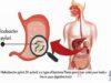 Helicobacter Pylori Infection, Causes, Signs and Symptoms, Diagnosis and Treatment.