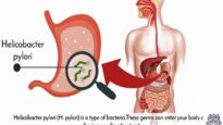 Helicobacter Pylori Infection, Causes, Signs and Symptoms, Diagnosis and Treatment.