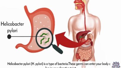 Helicobacter Pylori Infection, Causes, Signs and Symptoms, Diagnosis and Treatment.