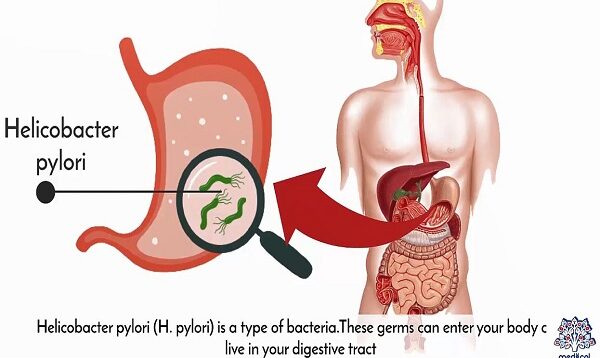Helicobacter Pylori Infection, Causes, Signs and Symptoms, Diagnosis and Treatment.