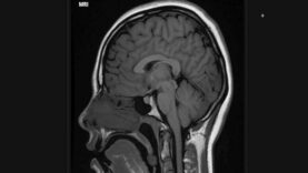 How to Read a Brain MRI Basic Search Pattern Sequences
