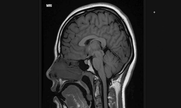 How to Read a Brain MRI Basic Search Pattern Sequences
