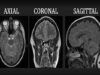 Introduction to MRI of the brain