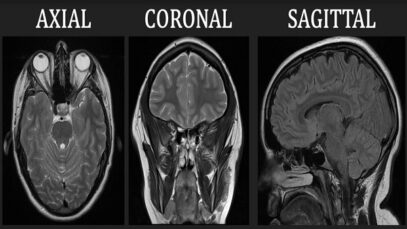 Introduction to MRI of the brain