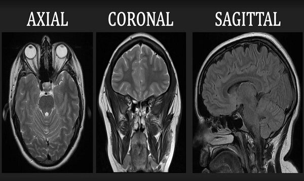 Introduction to MRI of the brain