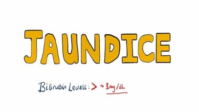 JAUNDICE Differential diagnosis of Jaundice – Prehepatic_Hepatic_Post Hepatic Causes of Jaundice