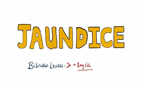 JAUNDICE Differential diagnosis of Jaundice – Prehepatic_Hepatic_Post Hepatic Causes of Jaundice