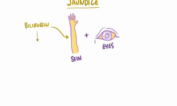 Jaundice Clinical Presentation