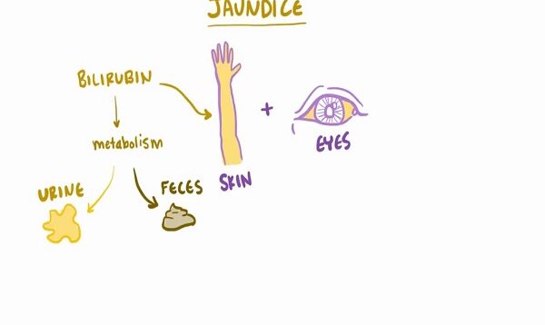 Jaundice, causes treatment pathology
