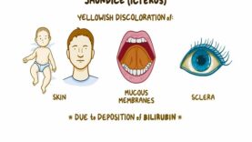 Jaundice_ Clinical Nursing Care
