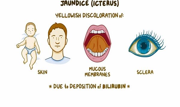 Jaundice_ Clinical Nursing Care
