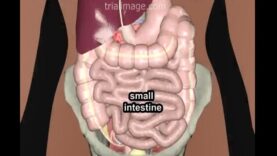 Laparoscopic Appendectomy