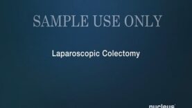 Laparoscopic Colectomy