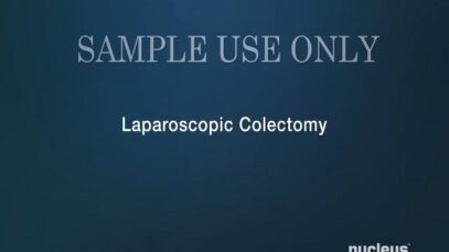 Laparoscopic Colectomy