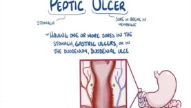 Peptic ulcer disease – causes, symptoms, diagnosis, treatment, pathology