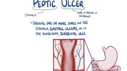 Peptic ulcer disease – causes, symptoms, diagnosis, treatment, pathology