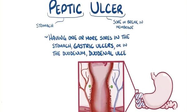 Peptic ulcer disease – causes, symptoms, diagnosis, treatment, pathology