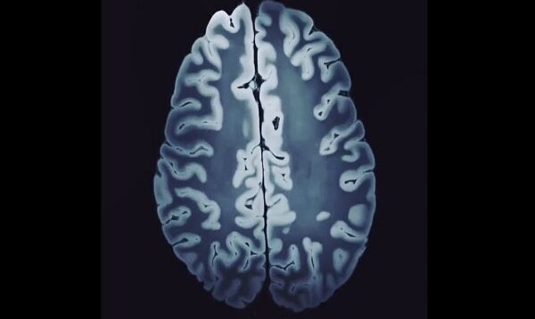 Tesla MRI The Highest Resolution Image of the Brain