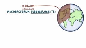 Tuberculosis – causes, symptoms, diagnosis, treatment, pathology