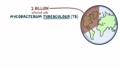 Tuberculosis – causes, symptoms, diagnosis, treatment, pathology
