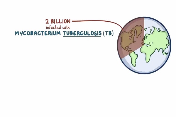 Tuberculosis – causes, symptoms, diagnosis, treatment, pathology