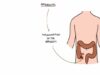 Understanding Appendicitis