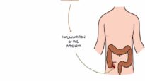 Understanding Appendicitis