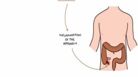 Understanding Appendicitis