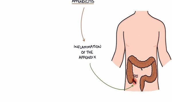 Understanding Appendicitis