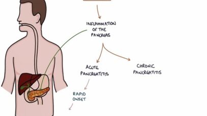 Understanding Pancreatitis