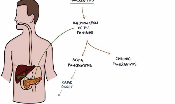 Understanding Pancreatitis