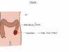Understanding Stomas (Colostomy, Ileostomy, Urostomy and Gastrostomy)