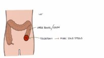 Understanding Stomas (Colostomy, Ileostomy, Urostomy and Gastrostomy)