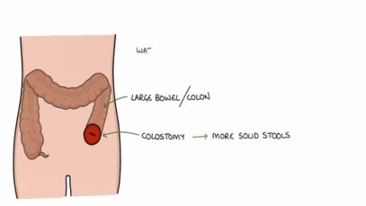 Understanding Stomas (Colostomy, Ileostomy, Urostomy and Gastrostomy)