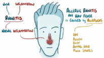 Allergic Rhinitis Clinical Presentation