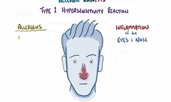 Allergic Rhinitis causes, symptoms, diagnosis, treatment