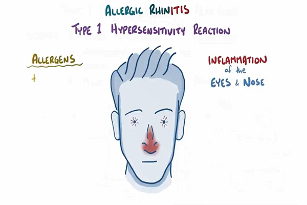 Allergic Rhinitis causes, symptoms, diagnosis, treatment