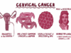 Cervical Cancer