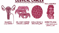 Cervical Cancer